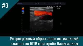 УЗИ вен. Ретроградный сброс через остиальный клапан по БПВ при пробе Вальсальвы.