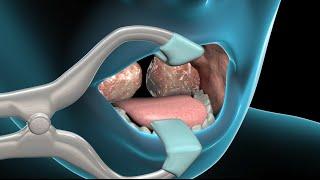 Tonsillectomy & Adenoidectomy | Nucleus Health