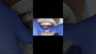 70 yr old man get full fixed teeth set /smile with dental impalnts + CAd cam miles GCam bridge-India