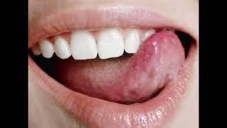 The Importance of Oral Cancer Screening (by your Dentist)