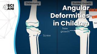 Bow legs and knock knees in children: when and how to correct them