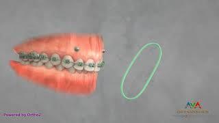 Orthodontic Treatment for Gummy Smile - TAD and Elastics