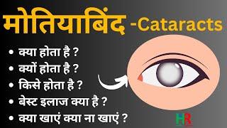 मोतियाबिंद के शुरूआती लक्षण और कारण क्या होते हैं || cataract complete information in hindi ||