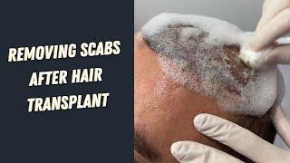 Removing scabs after 10 days hair transplant | Hair Transplant Turkey