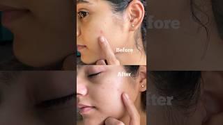 How do I treat my pus filled acne in 24 hour? Come watch ️ #acne #clinicalcosmetologist