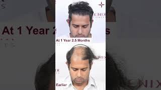 Hair Transplant in Gurugram | Best Results & Cost of Hair Transplant in Gurugram