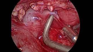 Subxiphoid VATS Thymectomy After Cardiac Surgery