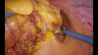 Laparosopic sigmoïdectomy for recurrent diverticulitis