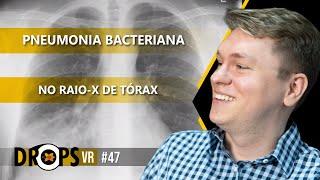 APRENDA COMO IDENTIFICAR A PNEUMONIA BACTERIANA NO RAIO X DE TÓRAX I VOCÊ RADIOLOGISTA