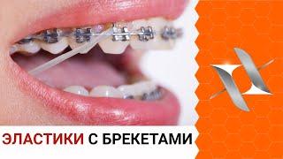 ЭЛАСТИКИ (тяги) и брекеты | Для чего? Как с ними жить?