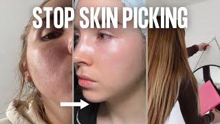 How I quit skin picking for GOOD: 3 steps for success