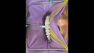 Orthodontic treatment by Dr Zuhaib #dentist #shorts