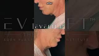 EVE Lift™ Before And After | Eden Plastic Surgery: Dr. Ali Charafeddine, MD