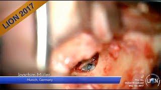 The 12th LION Global Broadcast Live Surgery Middle Ear Exploration Joachim Müller