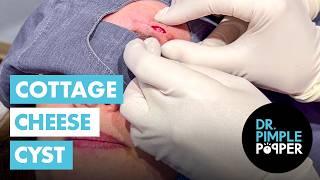 Cottage Cheese Cyst