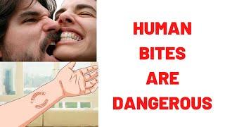 HUMAN BITES ARE DANGEROUS: Human Bites What To Do? : Human Bites Treatment- Symptoms- Complications