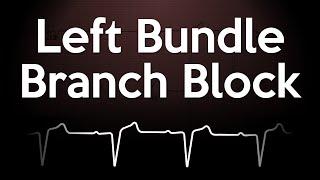 Left Bundle Branch Block ECG Explained