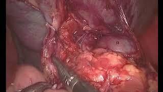 Dr. Mohamed Shehata, Laparoscopic splenectomy, Tanta University, Egypt