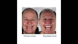 Eliminamos los focos de infección enfermedad periodontal generalizada con movilidad de piezas.