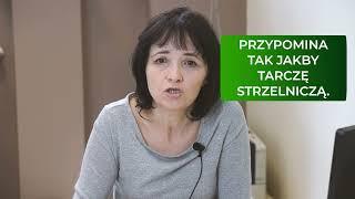 Czy przy zakażeniu boreliozą zawsze występuje rumień wędrujący?