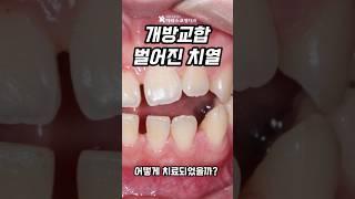 벌어지고 다물어지지 않는 #개방교합 치료 가능할까? #치아교정