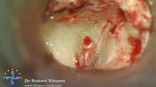 Lateralized Graft: Ossiculoplasty with TORP and Silastic Banding - Dr Robert Vincent