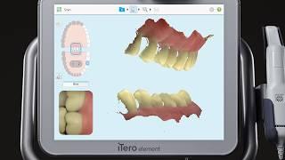 iTero® Scanner Tutorial: Pre-Treatment Scan