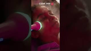 HydraFacial at Clear Skin Clinic: Your Path to Glowing Skin! | Clear Skin, Pune