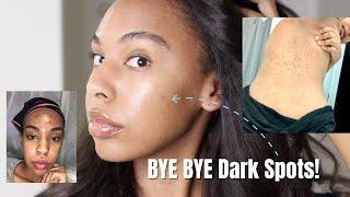 How to Get Rid of Dark Spots Hyperpigmentation! The safe way!