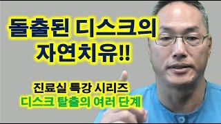 돌출된 디스크의 자연치유!!!