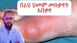 ቡና ሪህን እንደሚያክም ያውቃሉ በዚ vedio መጨረሻ ያገኙታል/gouty arthritis