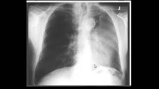 Chest Xray : Left upper lobe collapse ( by hammadshams)