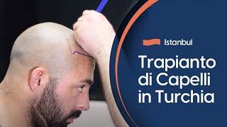 Quanto Costa un Trapianto di Capelli in Turchia