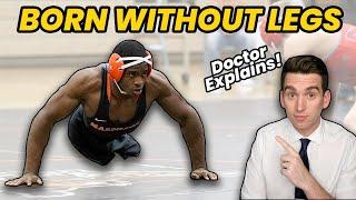 Born WITHOUT LEGS! Doctor Explains INSPIRING Story of Zion Clark