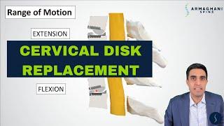 Cervical Disk Arthroplasty (Disk Replacement) Explained