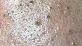 Relaxing Acne Treatment #21 (Spa Linh My Dang) P1