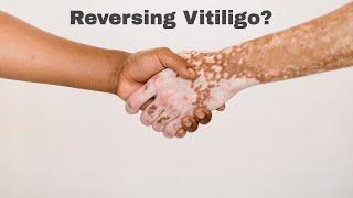 HOW I REVERSED MY VITILIGO | Lifestyle Changes to Reverse Autoimmune Symptoms