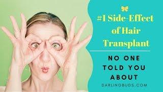 SIDE-EFFECTS of Hair Transplant | NO-ONE told you ABOUT !