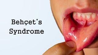 Behcet's Syndrome