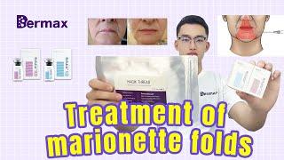 How to treat Marionette Folds with Botulinum Toxin|Botulinum Toxin|Botulax|Meditoxin|Nabota|Innotox