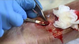 Bone Debridement