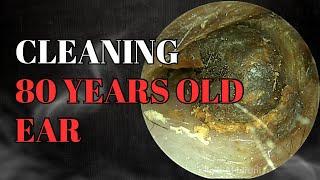 Cleaning 80 Years Old Ear