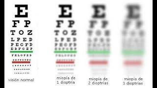 Simulación de la visión de un paciente miope