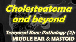 Temporal Bone Imaging (2): Middle Ear Disease