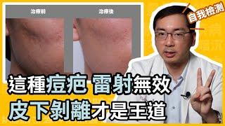 皮下剝離、皮下切割、皮下重建術 (subcision) ：滾動型凹痘疤的治療利器，皮膚科林政賢醫師一招教你如何判斷滾動型痘疤！