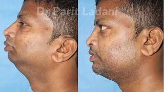 Sleep Apnea Treatment Results (Before/After) | Mandibular Retrognathia | Dr Parit Ladani