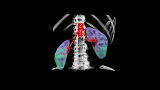 Fibromuscular Dysplasia of the Renal Arteries  #anatomy #SCCT #Emory #CTA #Topaz #Terarecon