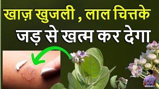 खाज़ खुजली , दाद ,लाल चित्तके जड़ से खत्म कर देगा ये पौधा .Benefit Of Madar Plant