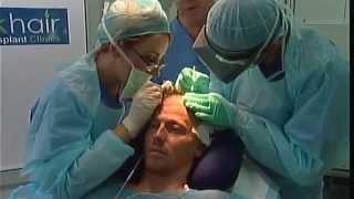 Celebrity Hair Transplant - Joe Swash Hair Transplant Surgery at UK Hair Transplant Clinics