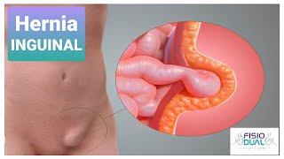 Ejercicios para Hernia Inguinal